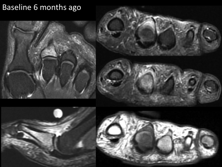 Figure 5 for case plantar plate of metatarsophalangeal joint ( RID3134 )